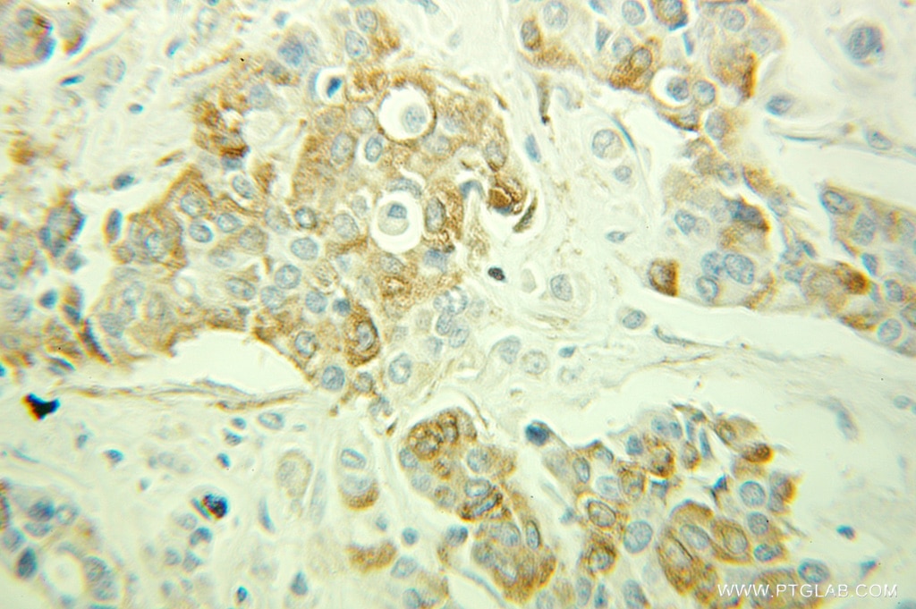 Immunohistochemistry (IHC) staining of human breast cancer tissue using ARPC1B Polyclonal antibody (10645-1-AP)
