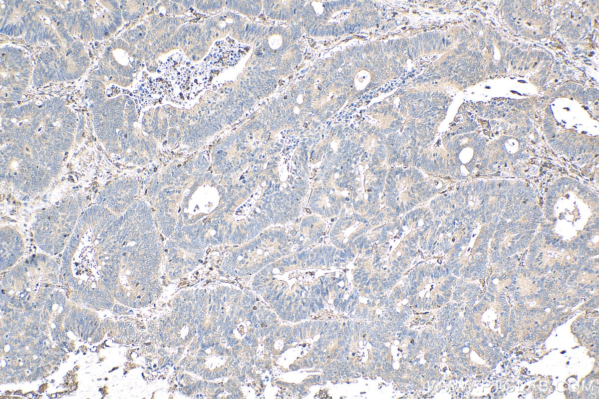 Immunohistochemistry (IHC) staining of human colon cancer tissue using ARPC1B Polyclonal antibody (28368-1-AP)