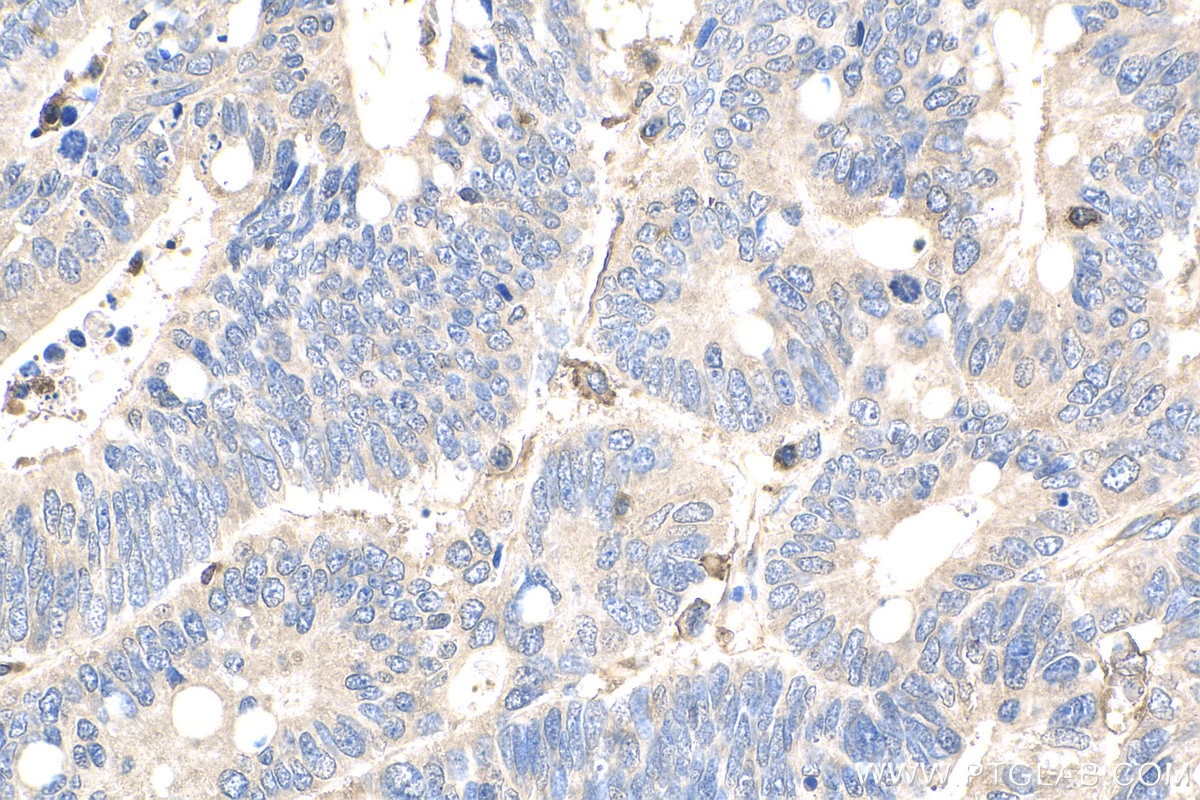 Immunohistochemistry (IHC) staining of human colon cancer tissue using ARPC1B Polyclonal antibody (28368-1-AP)