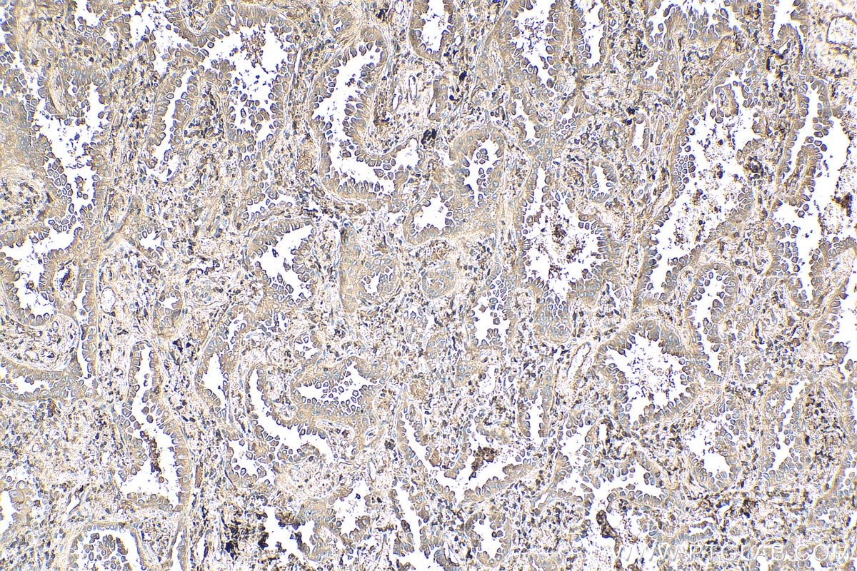 Immunohistochemistry (IHC) staining of human lung cancer tissue using ARPC1B Polyclonal antibody (28368-1-AP)