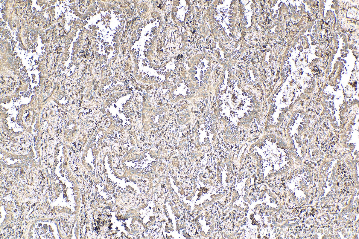 IHC staining of human lung cancer using 28368-1-AP