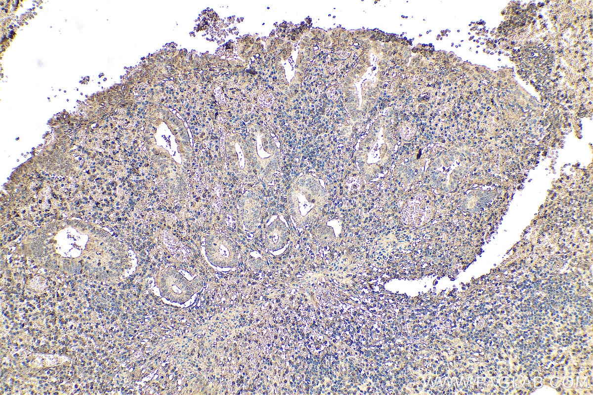 Immunohistochemistry (IHC) staining of human appendicitis tissue using ARPC1B Monoclonal antibody (67320-1-Ig)