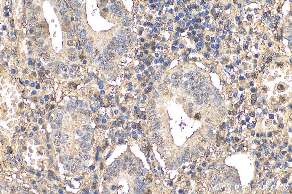 Immunohistochemistry (IHC) staining of human appendicitis tissue using ARPC1B Monoclonal antibody (67320-1-Ig)