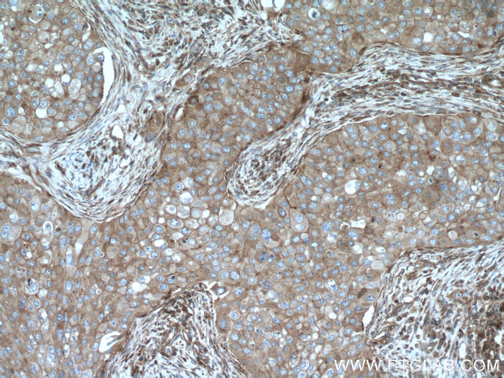 Immunohistochemistry (IHC) staining of human breast cancer tissue using ARPC2 Polyclonal antibody (15058-1-AP)