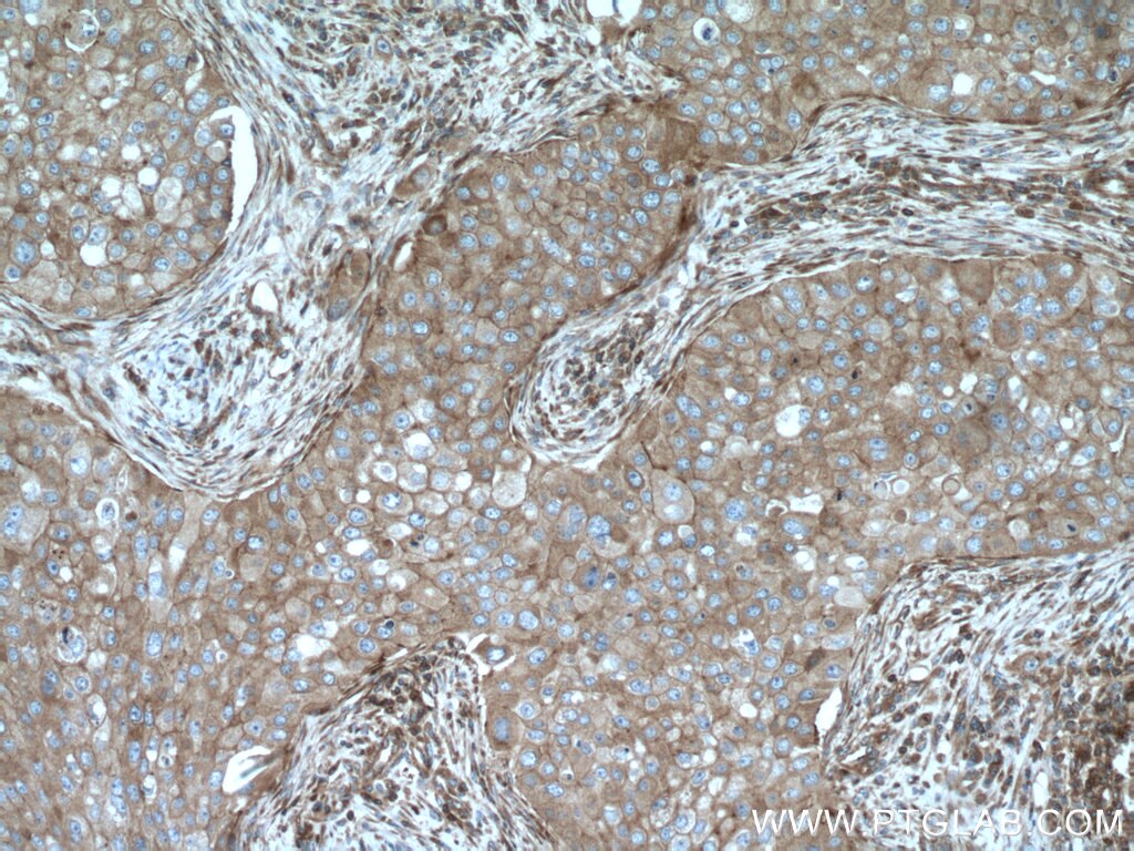 IHC staining of human breast cancer using 15058-1-AP