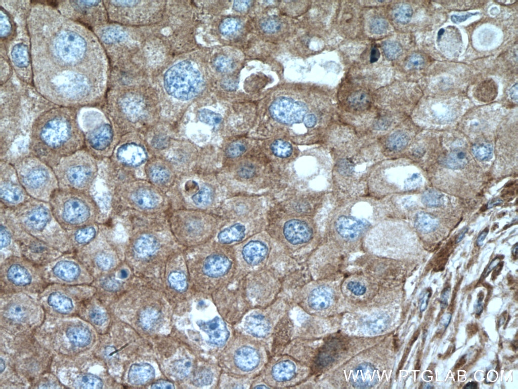 Immunohistochemistry (IHC) staining of human breast cancer tissue using ARPC2 Polyclonal antibody (15058-1-AP)