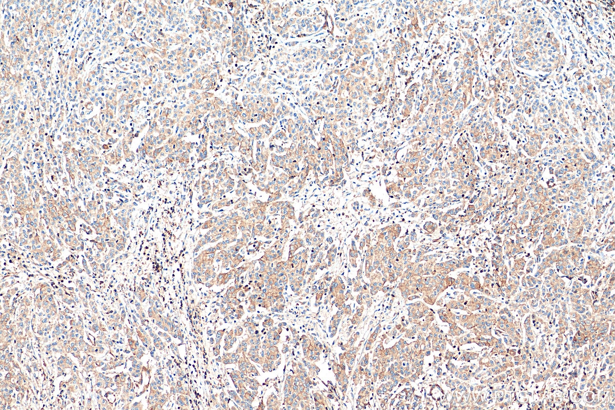 Immunohistochemistry (IHC) staining of human stomach cancer tissue using ARPC2 Monoclonal antibody (68145-1-Ig)