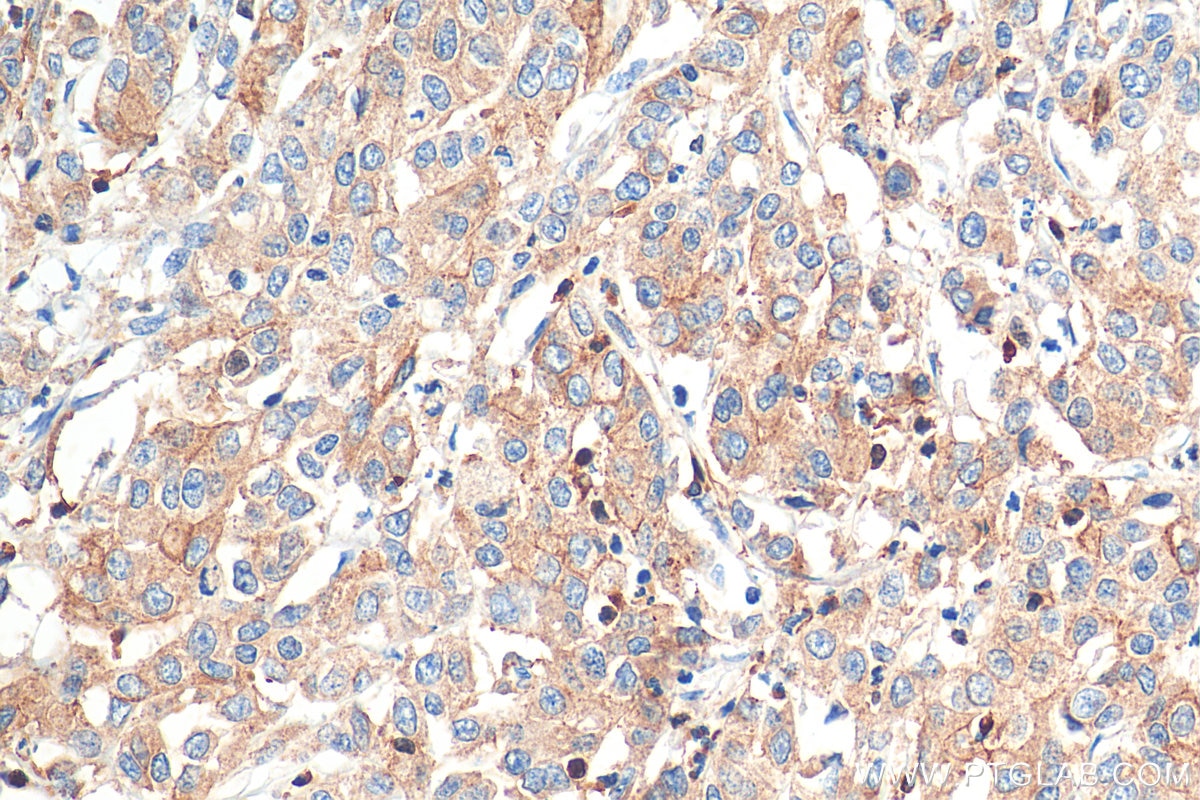 Immunohistochemistry (IHC) staining of human stomach cancer tissue using ARPC2 Monoclonal antibody (68145-1-Ig)