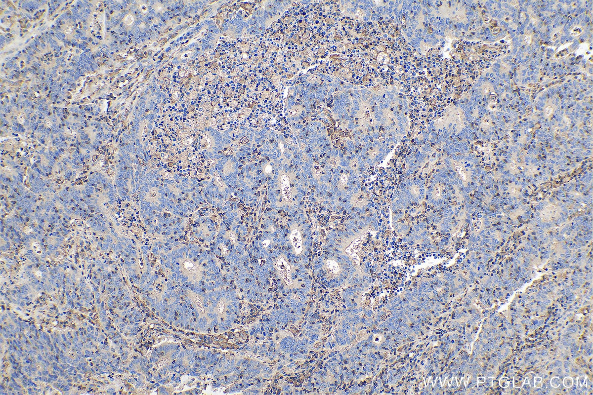 Immunohistochemistry (IHC) staining of human colon cancer tissue using ARPC3 Polyclonal antibody (14652-1-AP)