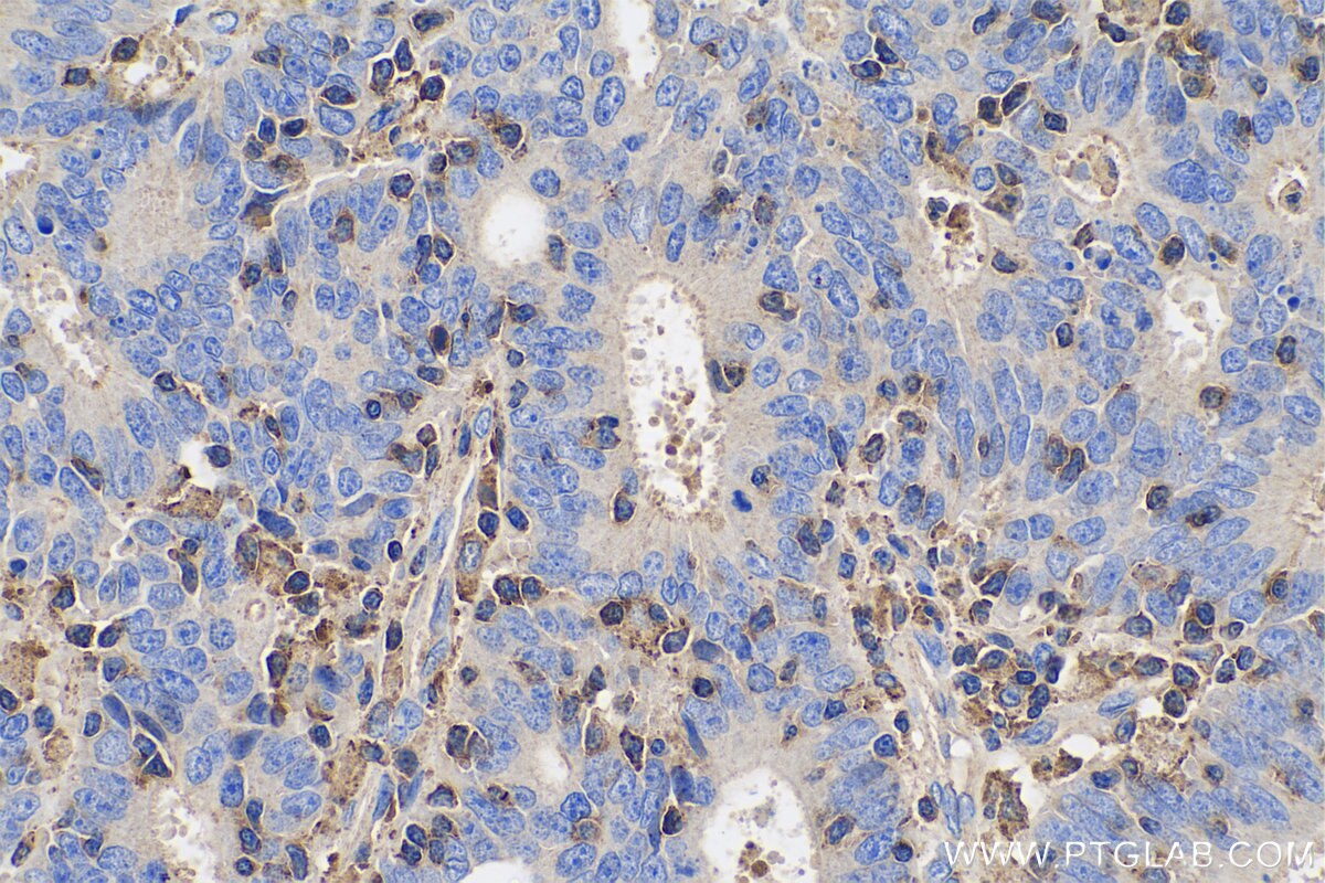 Immunohistochemistry (IHC) staining of human colon cancer tissue using ARPC3 Polyclonal antibody (14652-1-AP)