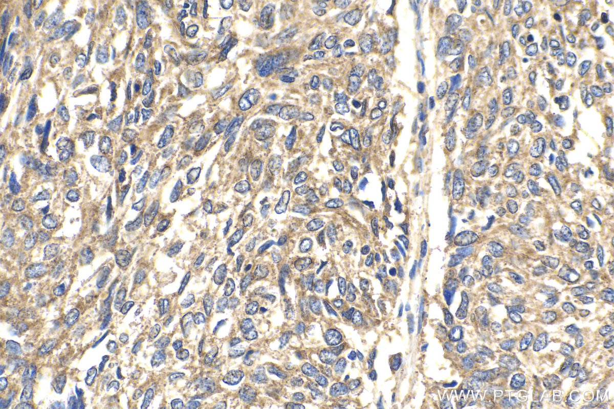 Immunohistochemistry (IHC) staining of human cervical cancer tissue using ARPC4 Polyclonal antibody (10930-1-AP)
