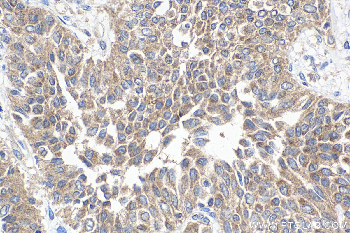 Immunohistochemistry (IHC) staining of human urothelial carcinoma tissue using ARPC4 Polyclonal antibody (10930-1-AP)
