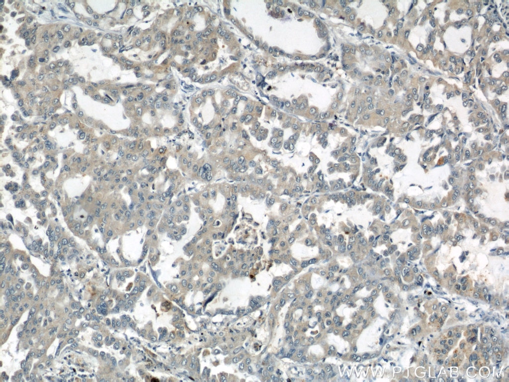 IHC staining of human lung cancer using 10930-1-AP