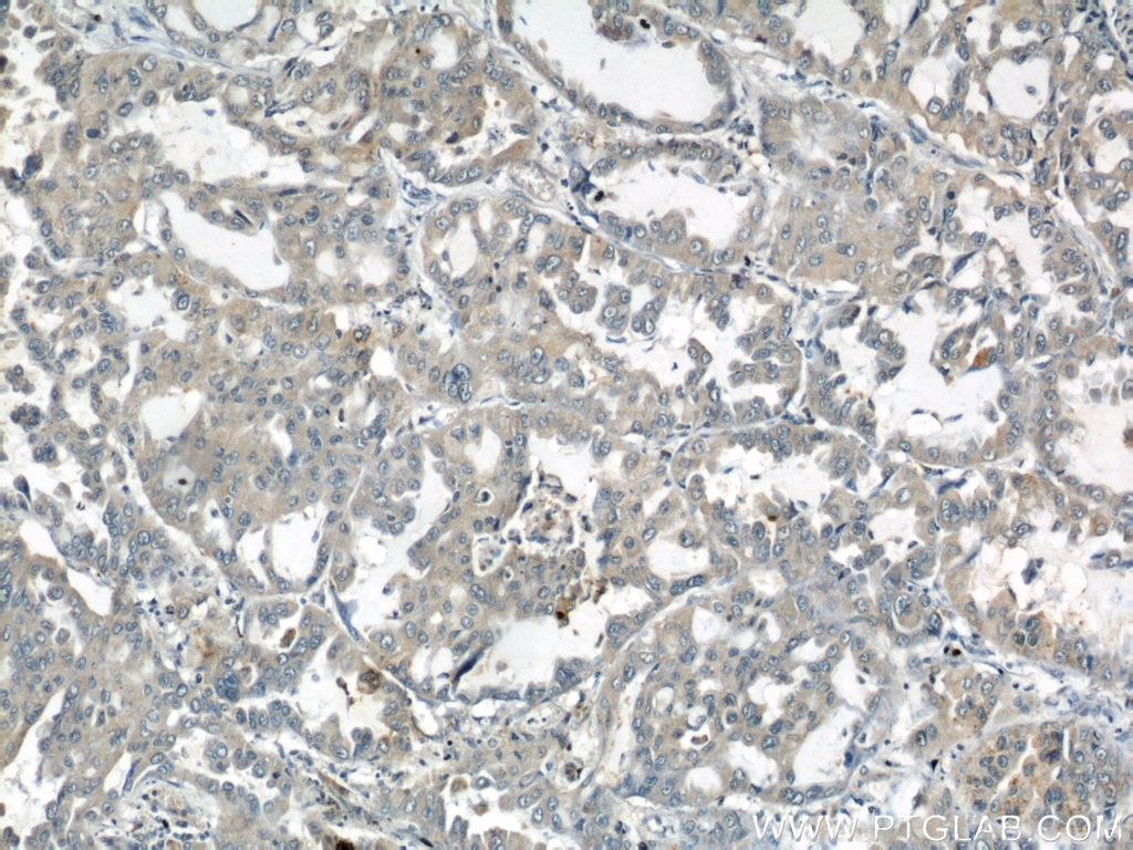 Immunohistochemistry (IHC) staining of human lung cancer tissue using ARPC4 Polyclonal antibody (10930-1-AP)