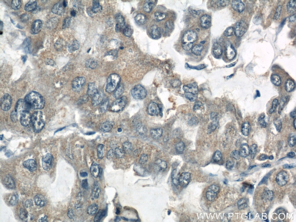 Immunohistochemistry (IHC) staining of human lung cancer tissue using ARPC4 Polyclonal antibody (10930-1-AP)