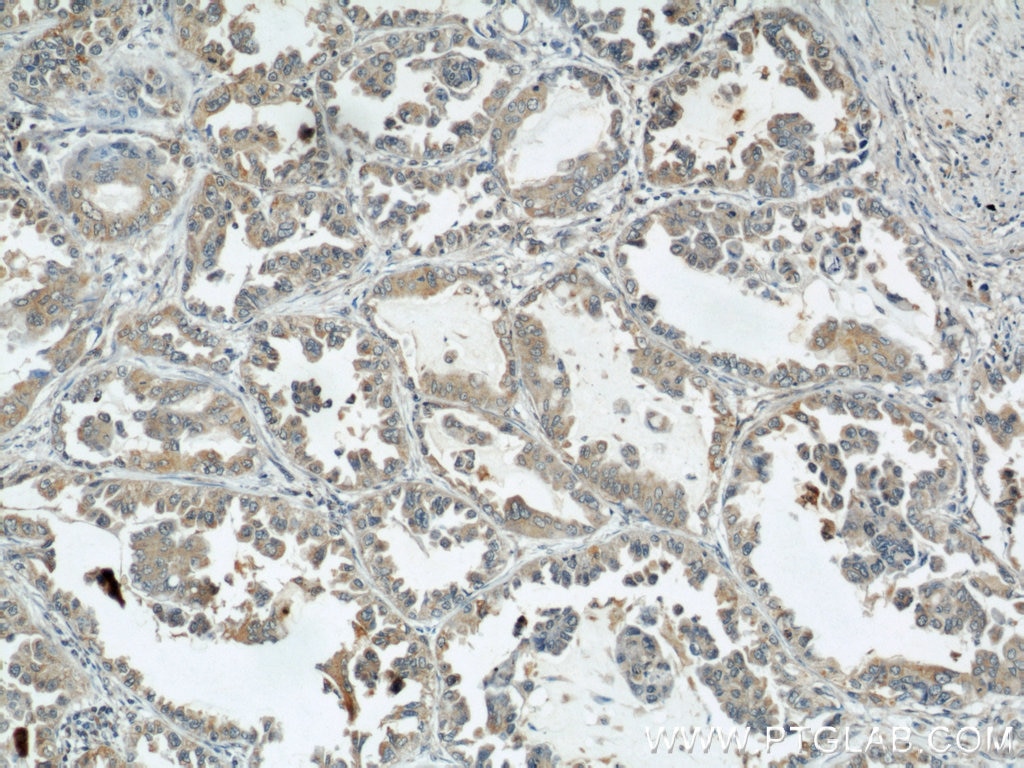 IHC staining of human lung cancer using 10930-1-AP