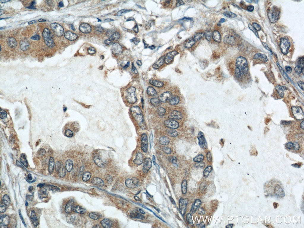 Immunohistochemistry (IHC) staining of human lung cancer tissue using ARPC4 Polyclonal antibody (10930-1-AP)