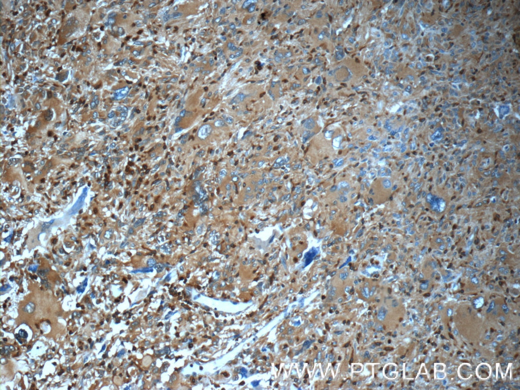 Immunohistochemistry (IHC) staining of human gliomas tissue using ARPC5 Polyclonal antibody (16717-1-AP)