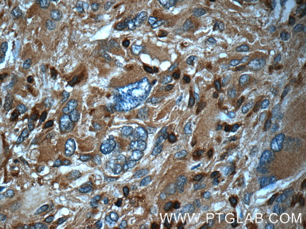 IHC staining of human gliomas using 16717-1-AP