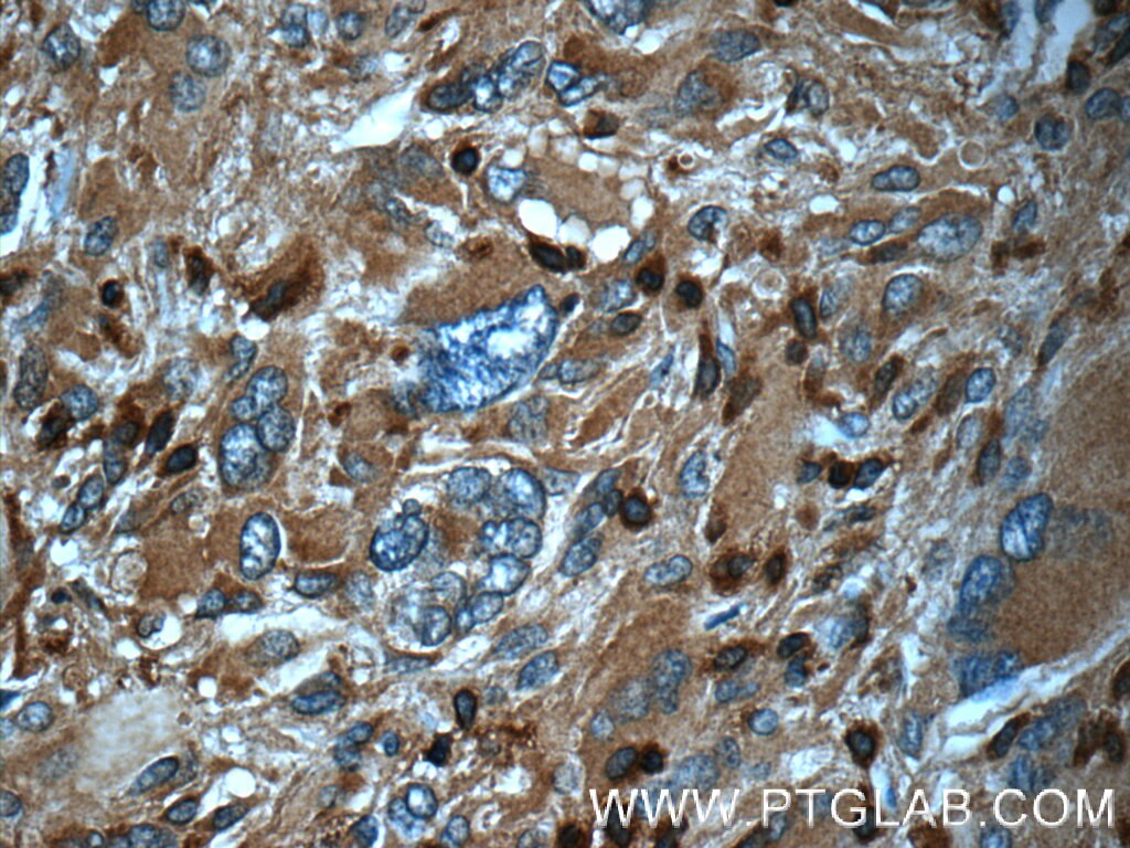 Immunohistochemistry (IHC) staining of human gliomas tissue using ARPC5 Polyclonal antibody (16717-1-AP)