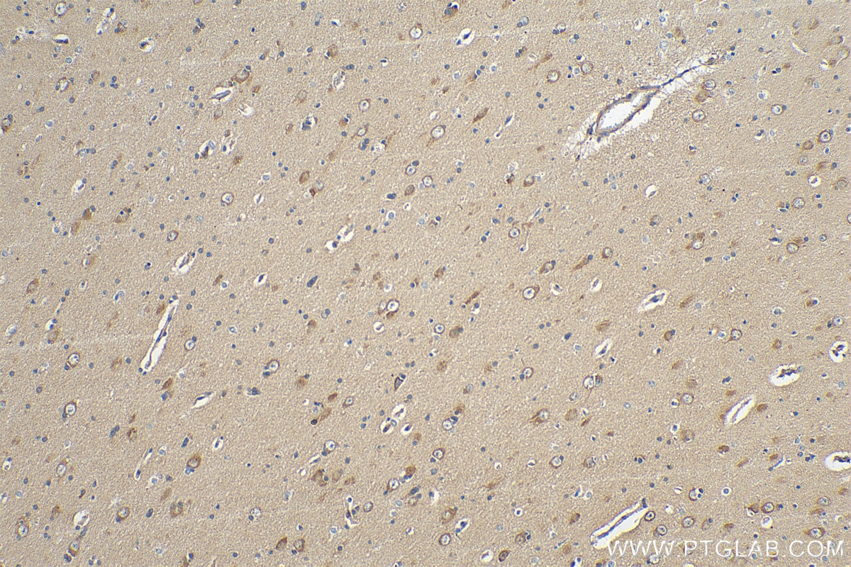 Immunohistochemistry (IHC) staining of human gliomas tissue using ARPP-19 Polyclonal antibody (11678-1-AP)