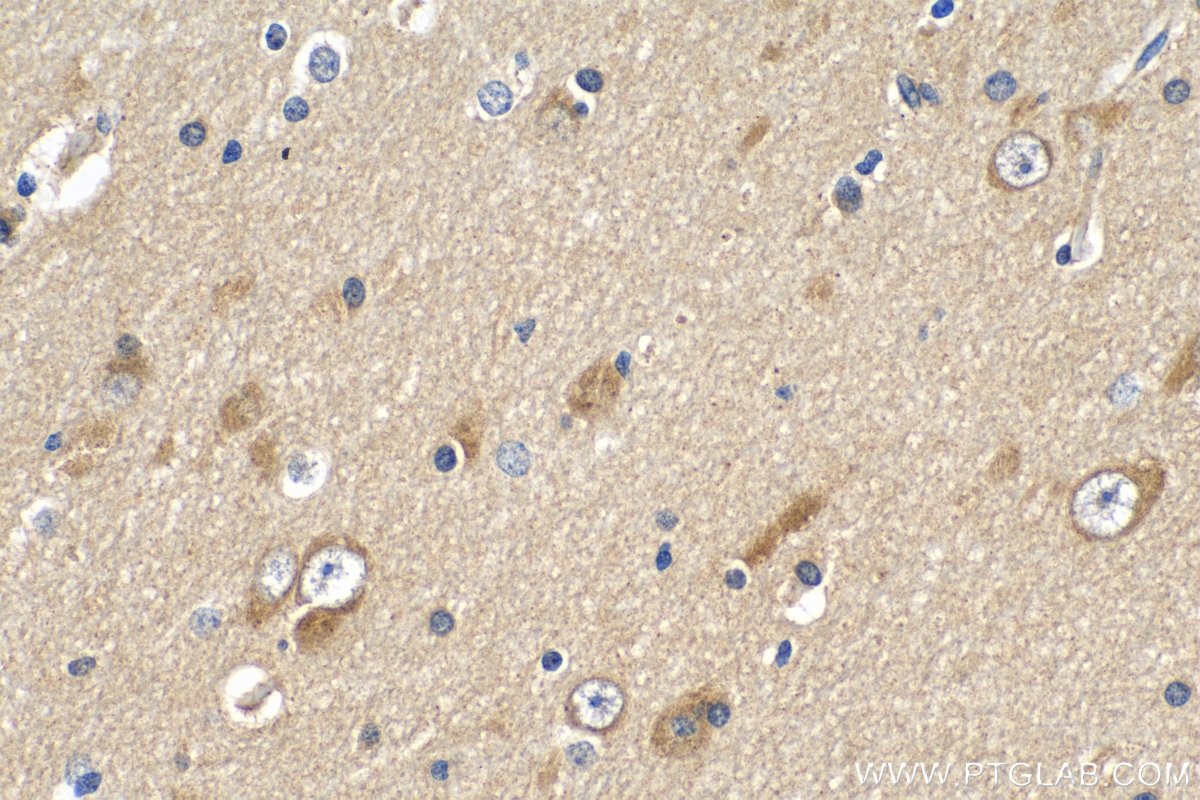 Immunohistochemistry (IHC) staining of human gliomas tissue using ARPP-19 Polyclonal antibody (11678-1-AP)