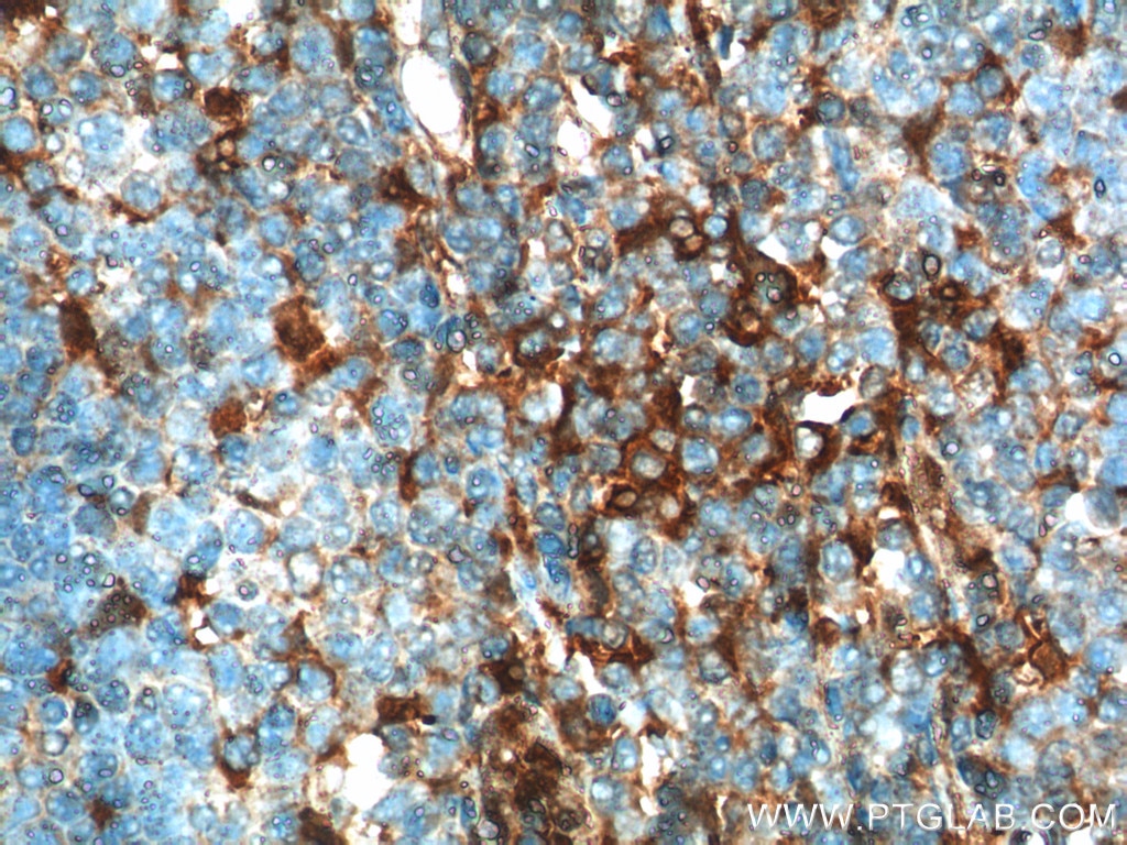 IHC staining of human tonsillitis using 15361-1-AP