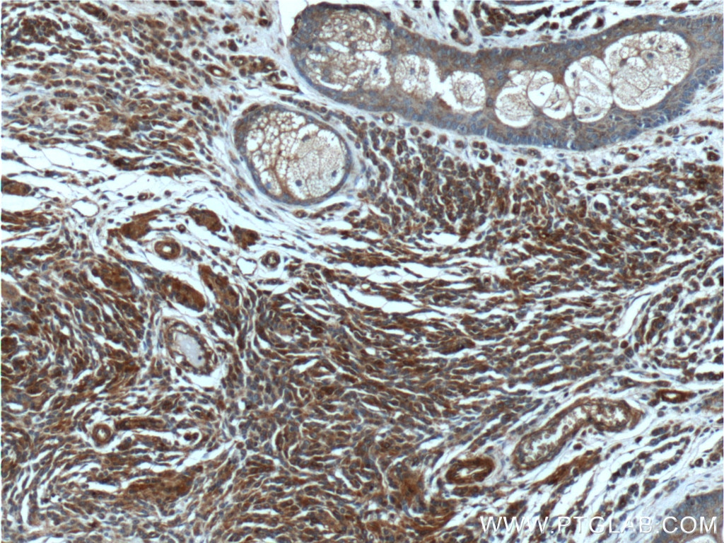 Immunohistochemistry (IHC) staining of human malignant melanoma tissue using Beta Arrestin 2 Polyclonal antibody (10171-1-AP)