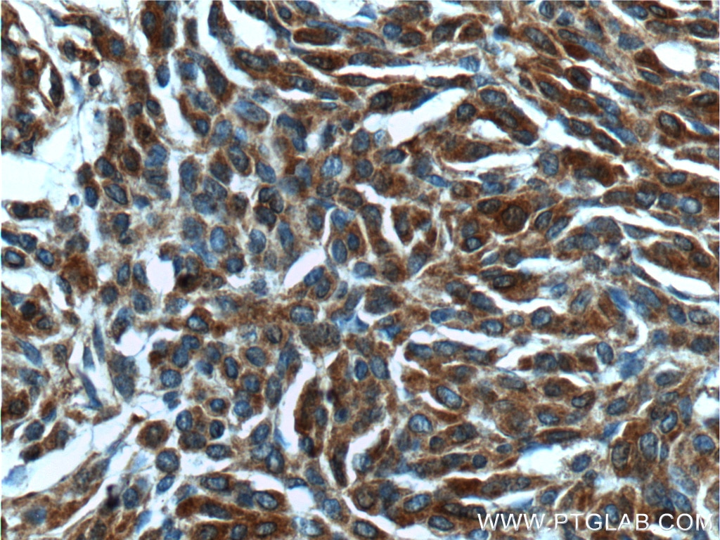 Immunohistochemistry (IHC) staining of human malignant melanoma tissue using Beta Arrestin 2 Polyclonal antibody (10171-1-AP)