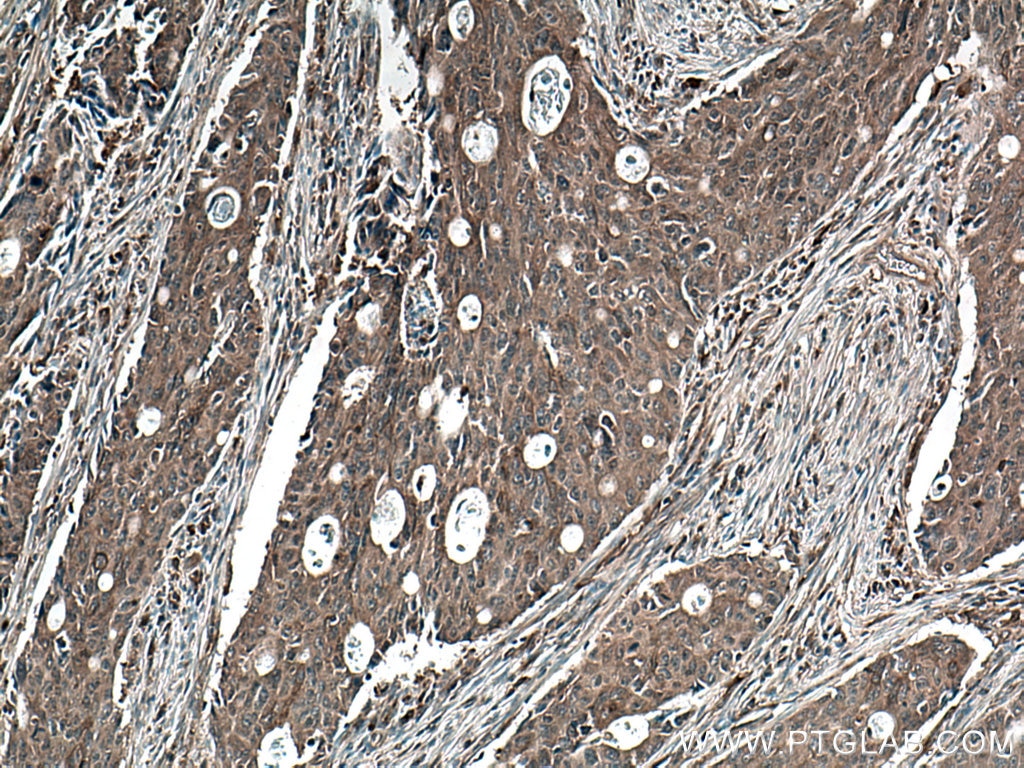 Immunohistochemistry (IHC) staining of human colon cancer tissue using Beta Arrestin 2 Polyclonal antibody (10171-1-AP)