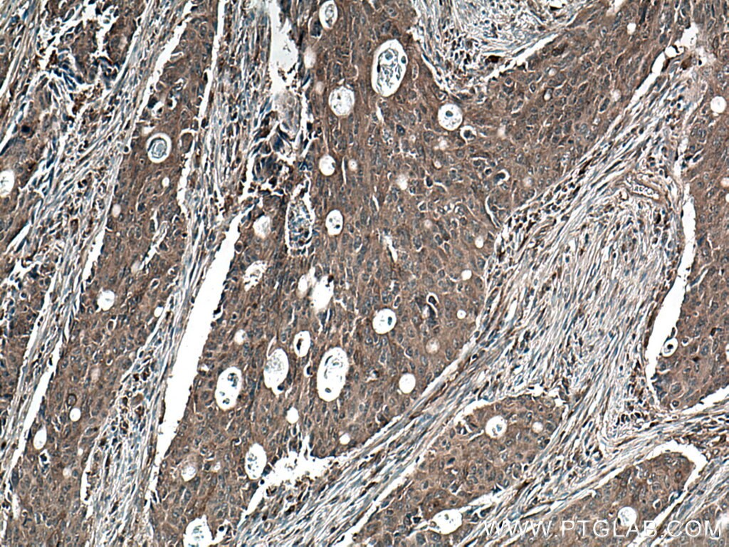 Immunohistochemistry (IHC) staining of human colon cancer tissue using Beta Arrestin 2 Polyclonal antibody (10171-1-AP)
