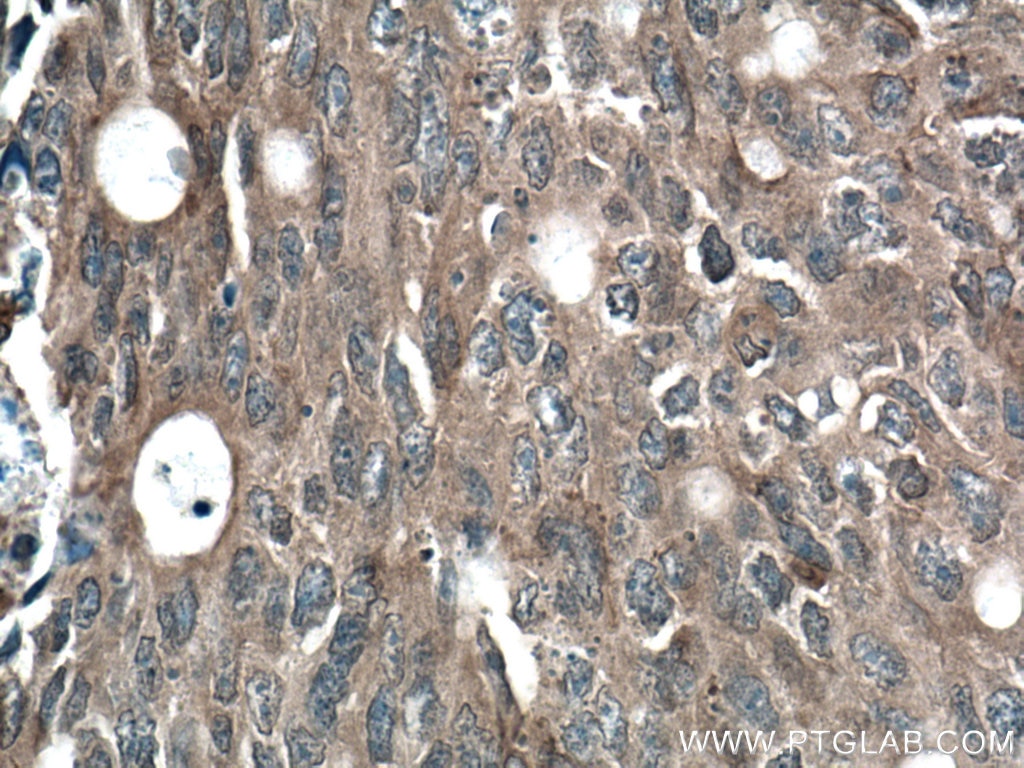 Immunohistochemistry (IHC) staining of human colon cancer tissue using Beta Arrestin 2 Polyclonal antibody (10171-1-AP)
