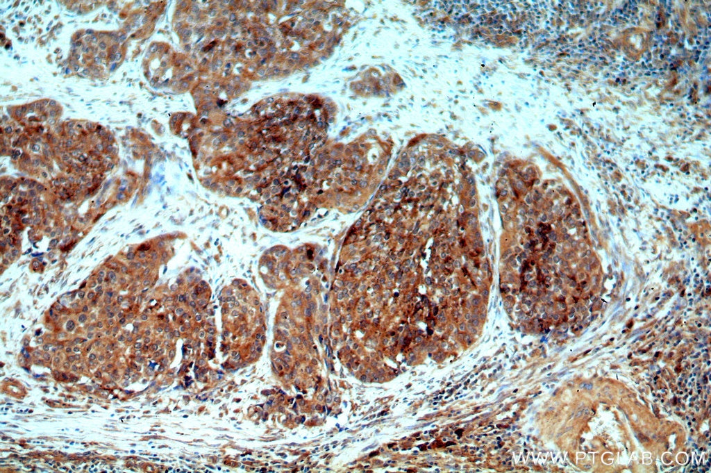 Immunohistochemistry (IHC) staining of human cervical cancer tissue using ARSA Polyclonal antibody (19061-1-AP)