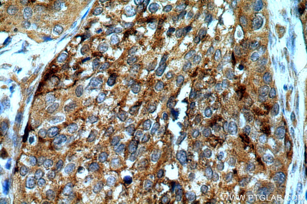 Immunohistochemistry (IHC) staining of human cervical cancer tissue using ARSA Polyclonal antibody (19061-1-AP)