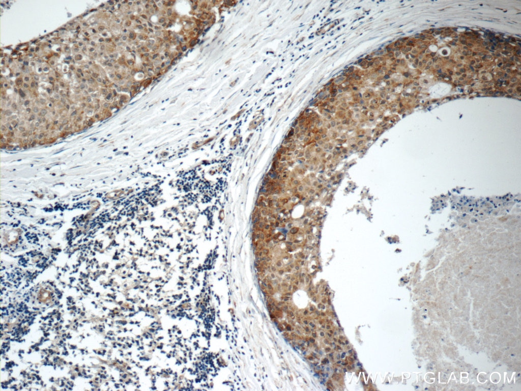 Immunohistochemistry (IHC) staining of human breast cancer tissue using ARSB Polyclonal antibody (13227-1-AP)