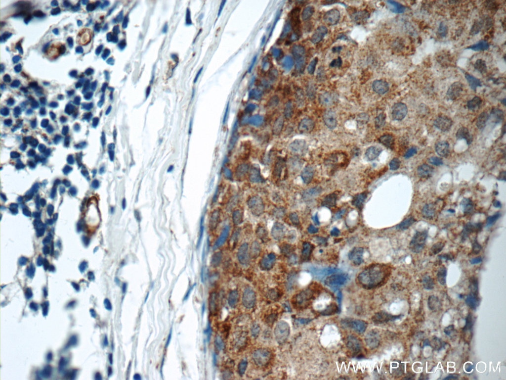 Immunohistochemistry (IHC) staining of human breast cancer tissue using ARSB Polyclonal antibody (13227-1-AP)