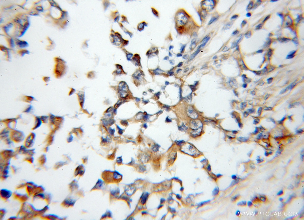 Immunohistochemistry (IHC) staining of human breast cancer tissue using Arylsulfatase D Polyclonal antibody (11805-1-AP)