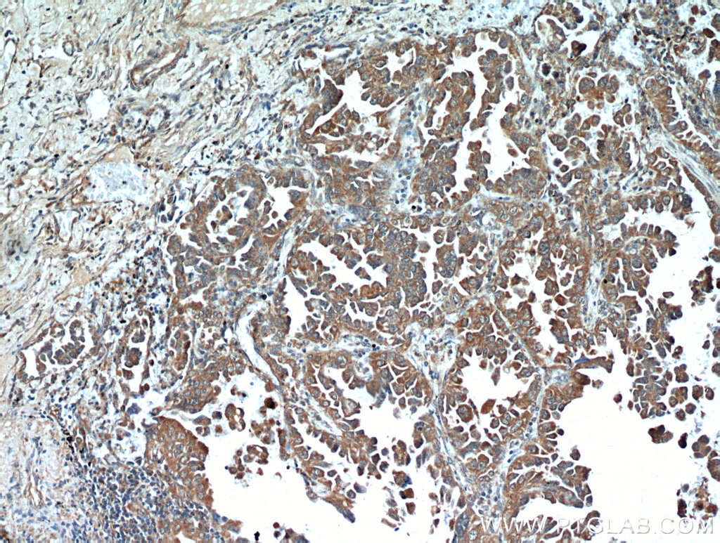 IHC staining of human lung cancer using 11354-1-AP