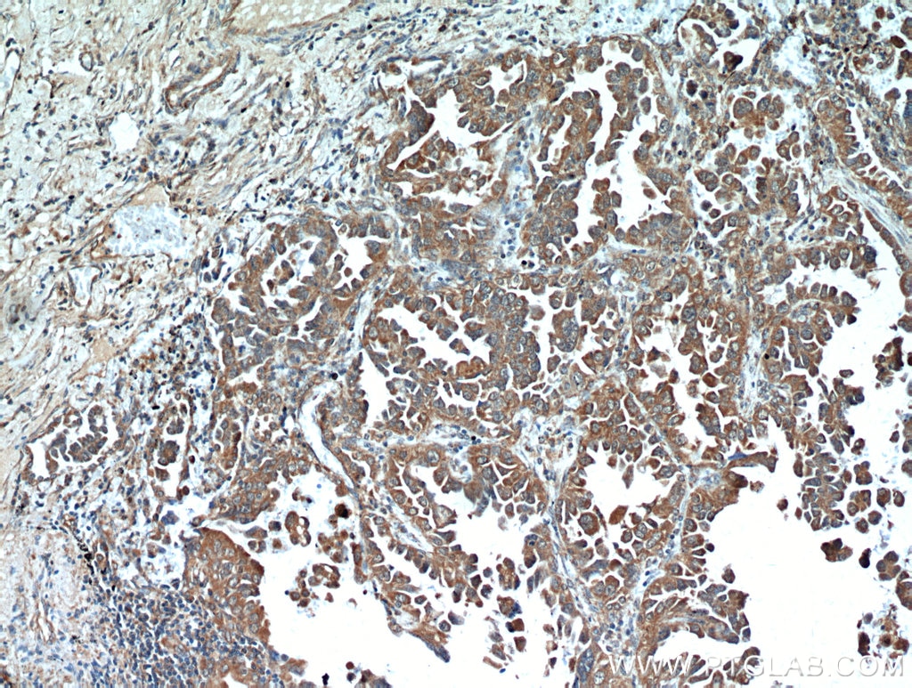 Immunohistochemistry (IHC) staining of human lung cancer tissue using ART5 Polyclonal antibody (11354-1-AP)