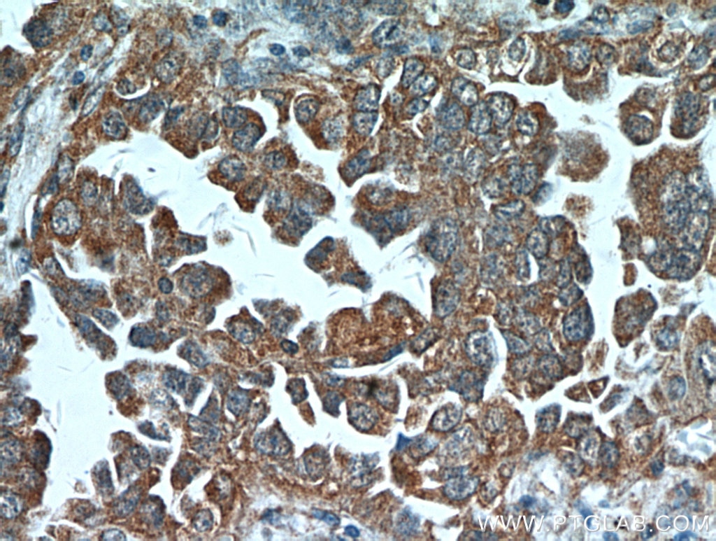 Immunohistochemistry (IHC) staining of human lung cancer tissue using ART5 Polyclonal antibody (11354-1-AP)