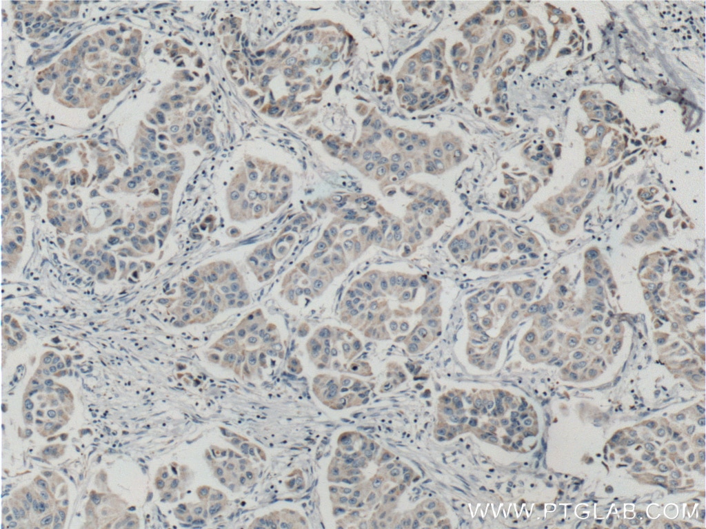 IHC staining of human breast cancer using 11274-1-AP