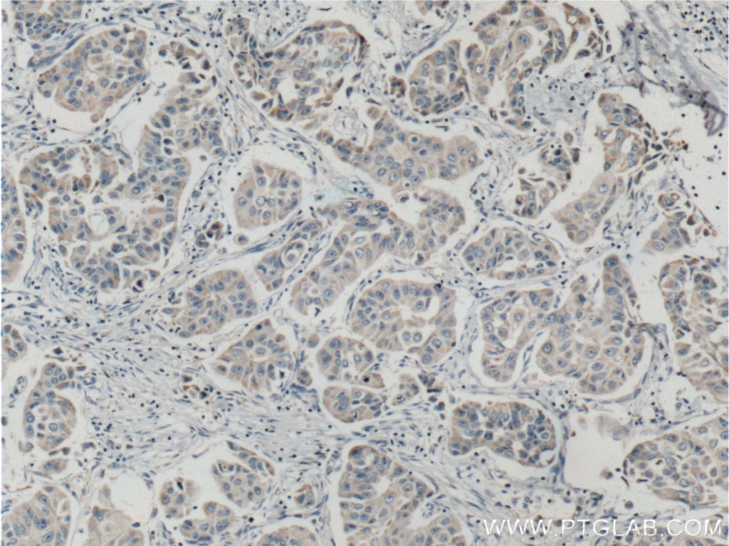 Immunohistochemistry (IHC) staining of human breast cancer tissue using ASAH1 Polyclonal antibody (11274-1-AP)