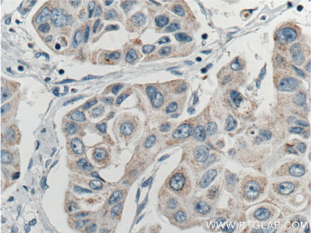 Immunohistochemistry (IHC) staining of human breast cancer tissue using ASAH1 Polyclonal antibody (11274-1-AP)