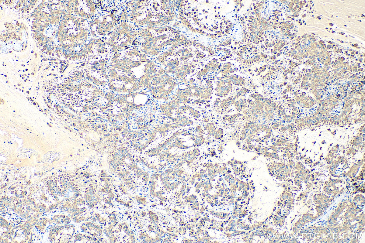 Immunohistochemistry (IHC) staining of human lung cancer tissue using ASAH1 Polyclonal antibody (11274-1-AP)