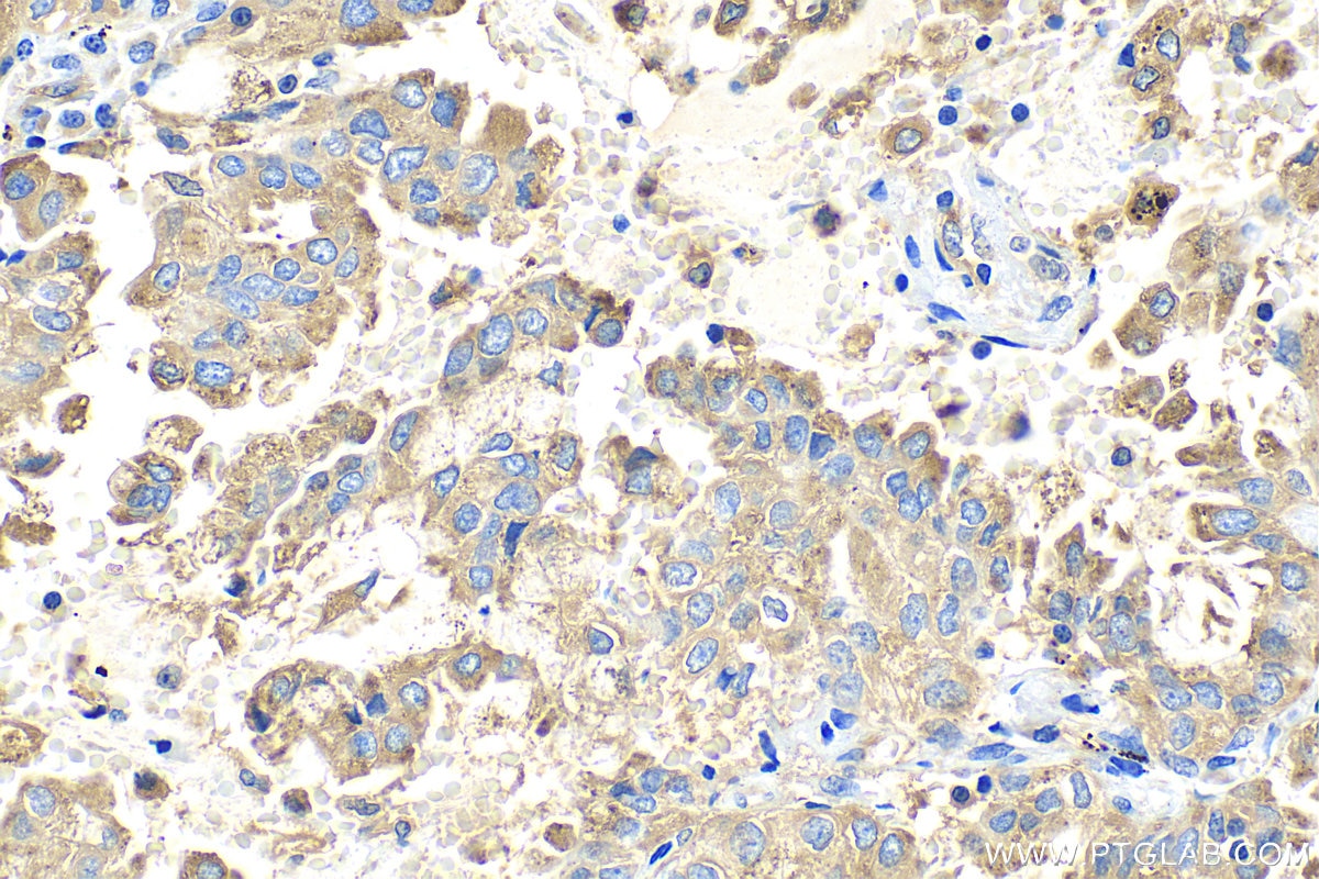 Immunohistochemistry (IHC) staining of human lung cancer tissue using ASAH1 Polyclonal antibody (11274-1-AP)