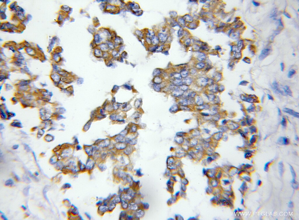 Immunohistochemistry (IHC) staining of human breast cancer tissue using ASAH1 Polyclonal antibody (11274-1-AP)