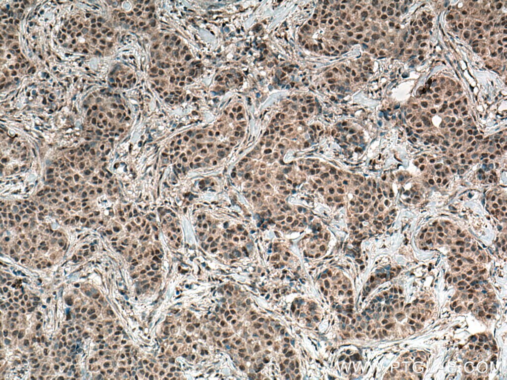 Immunohistochemistry (IHC) staining of human breast cancer tissue using ASAH1 Monoclonal antibody (67092-1-Ig)