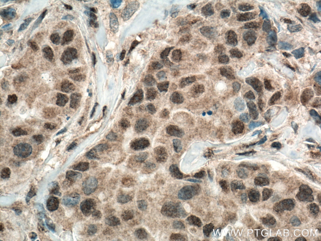 Immunohistochemistry (IHC) staining of human breast cancer tissue using ASAH1 Monoclonal antibody (67092-1-Ig)