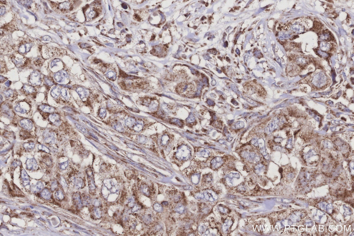Immunohistochemistry (IHC) staining of human pancreas cancer tissue using ASAH2 Polyclonal antibody (27742-1-AP)