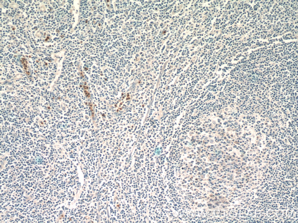 Immunohistochemistry (IHC) staining of human tonsillitis tissue using ASB14 Polyclonal antibody (25300-1-AP)